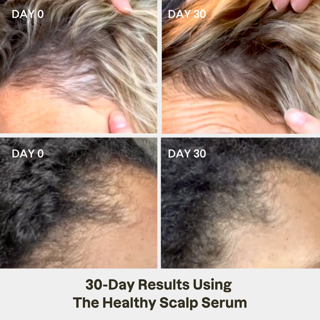 Healthy Scalp Serum  <br> 1 Case (6 UNITS)