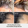 Healthy Scalp Serum  <br> 1 Case (6 UNITS)